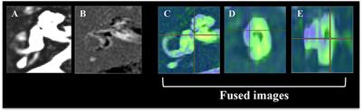 Three-Dimensional Magnetic Resonance Imaging Reveals the Relationship Between the Control of Vertigo and Decreases in Endolymphatic Hydrops After Endolymphatic Sac Drainage With Steroids for Meniere's Disease